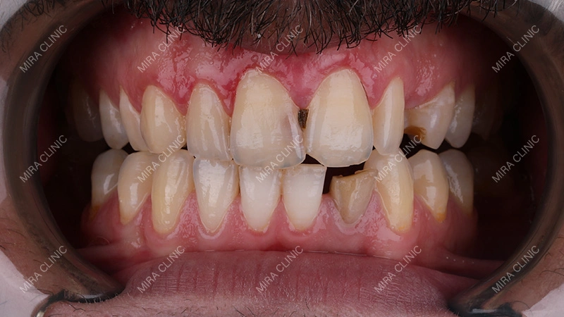 Broken or Cracked Teeth